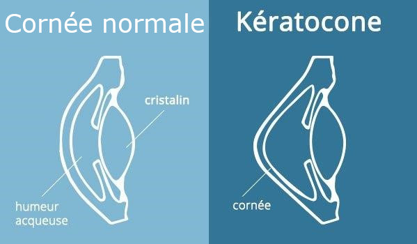 Qu'est-ce qu'un kératocône?